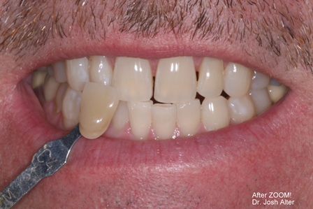 After-Zoom-Whitening.JPG