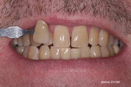 Before-Zoom-Whitening.JPG