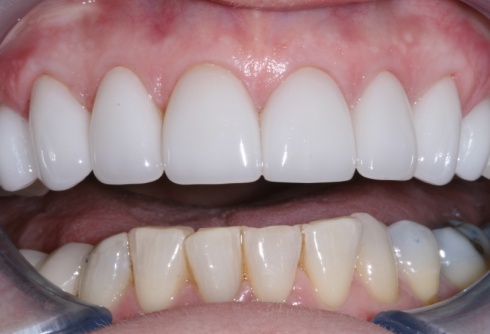 afterveneers_1.jpg