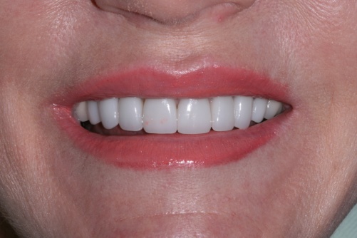 afterveneers_2.jpg