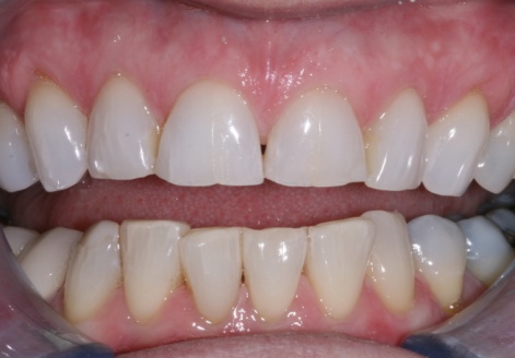 beforeveneers_1.jpg