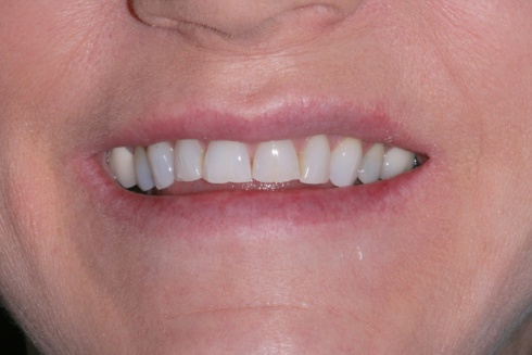 beforeveneers_2.jpg