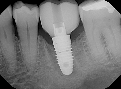 dentalimplant2.png