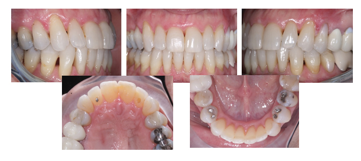 invisalign_after